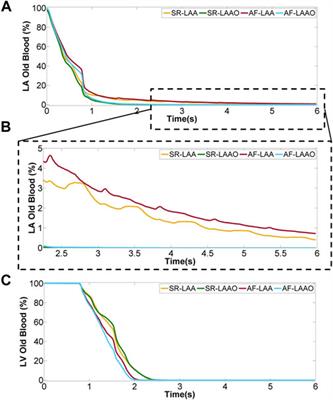 Left atrial appendage occlusion in ventricular assist device patients to decrease thromboembolic events: A computer simulation study